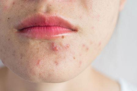 Porcentaje Especialmente formal Efectos del uso de gel y mascarilla: alergia y agravamiento de acné y  rosácea